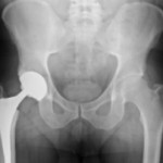 Kyros Law Group | Hip/Knee Implants