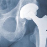 Stryker Hip Replacement