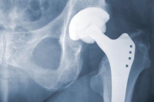 Stryker Hip Replacement