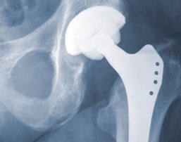 Hip Replacement Lawsuit